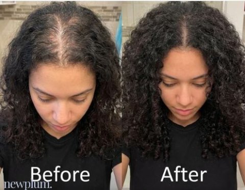Buy Newplum Advanced Hair Growth Roll-On Serum Online