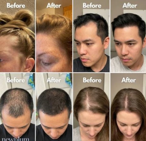 Buy Newplum Advanced Hair Growth Roll-On Serum Online